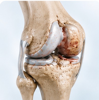 Anatomical illustration of an arthritic knee joint